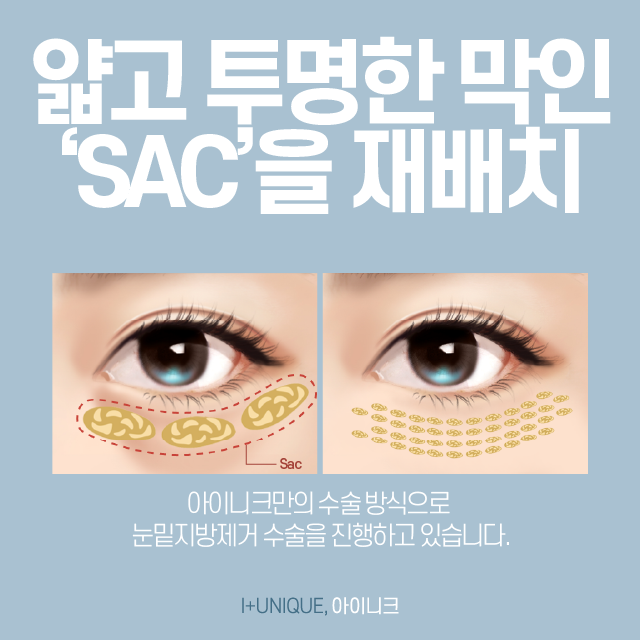 눈지방 눈밑지방제거수술로 변화하기 관련 이미지 3