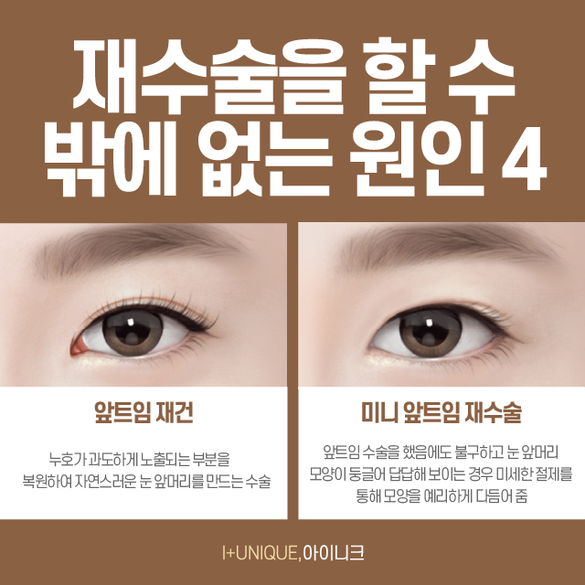 If you’re worried about uneven eyes after eye surgery, Ineek’s one-sided revision surgery is the answer! image 5