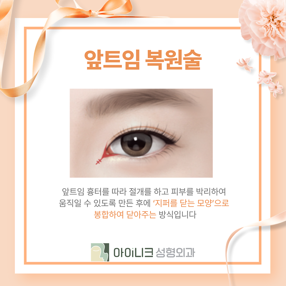 눈재수술잘하는곳 과도한 앞트임 재건이 문제라면 관련 이미지 11