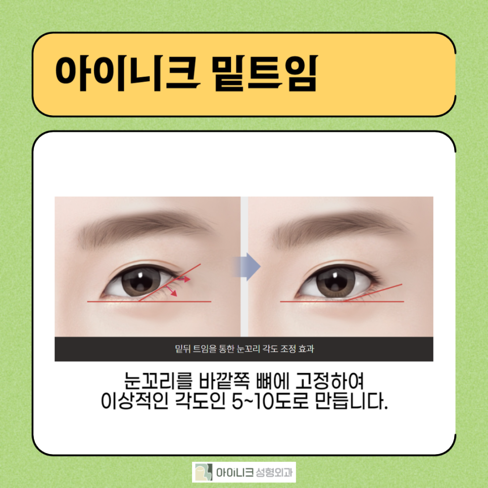 눈꼬리내리는수술로 강아지상 만들기 관련 이미지 5