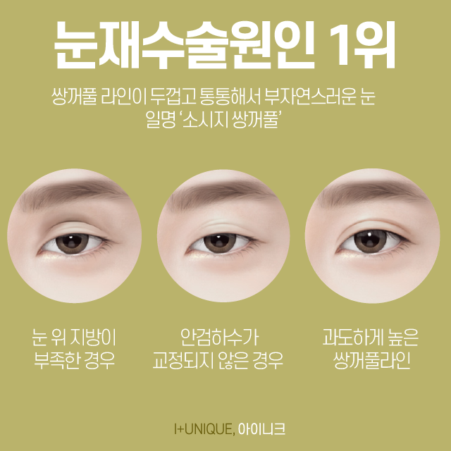 쌍수재수술병원을 고를 땐 의사의 실력이 중요합니다 관련 이미지 2