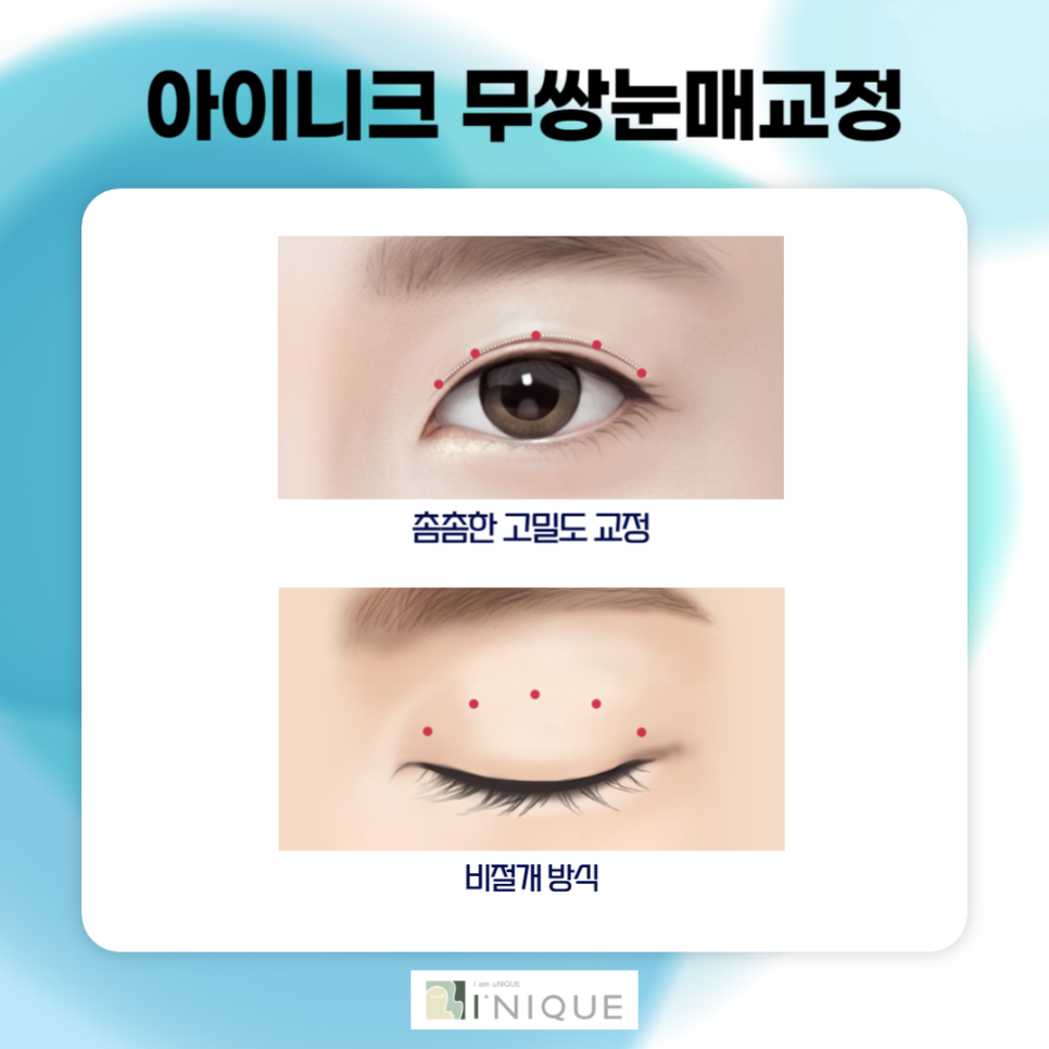 강남남자눈성형 부담스럽지 않은 또렷한 인상으로 관련 이미지 4
