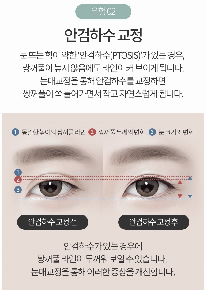 소시지쌍꺼풀 원인부터 파악하자! 관련 이미지 5