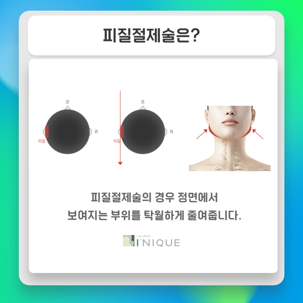 Key Points of Facial Contouring Surgery image 5