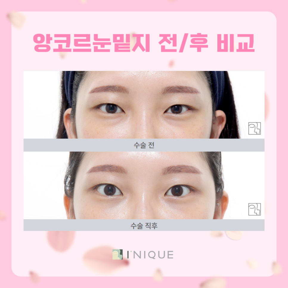눈밑지방재배치 왜 성형외과 전문의인가 관련 이미지 6