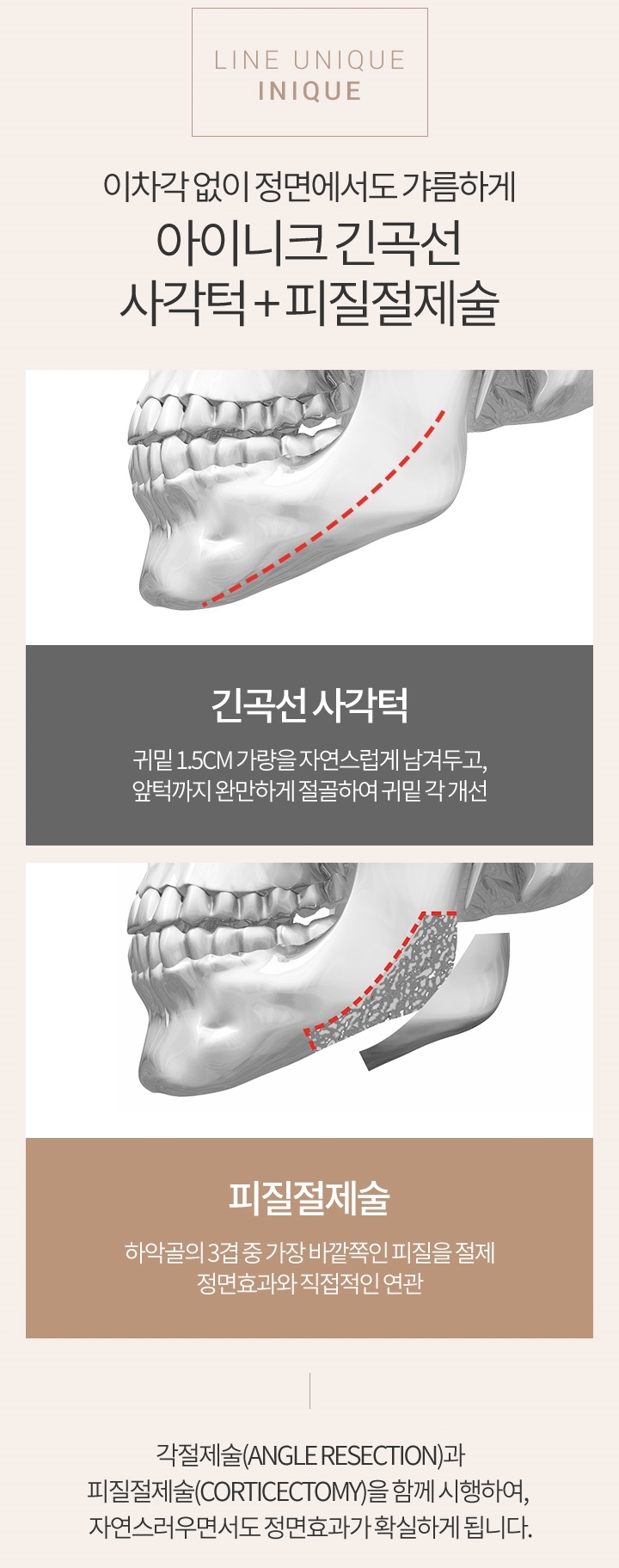 피질절제술로 정면에서도 V라인 관련 이미지 2