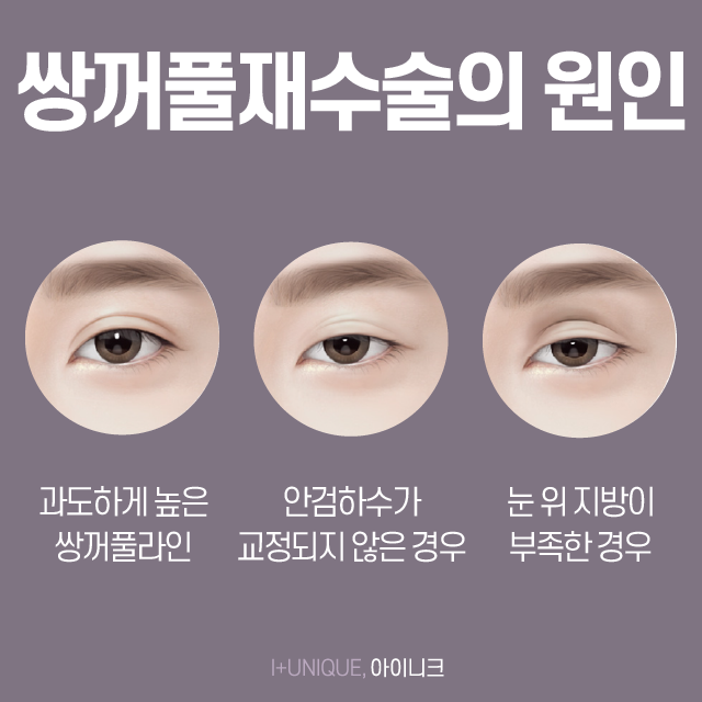 No More Failures! Get a Consultation on Revision Double Eyelid Surgery and Cost image 2