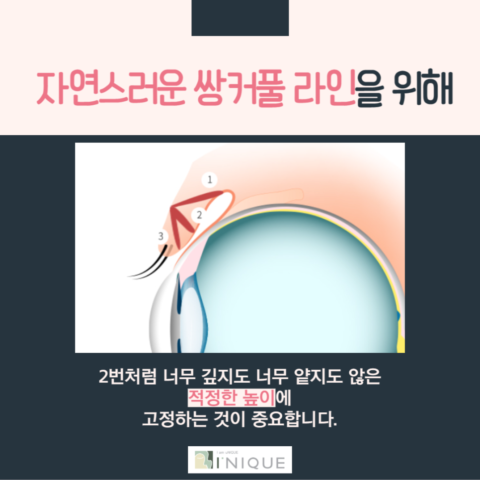 첫눈수술, 내 눈은 소중하니까! 관련 이미지 4