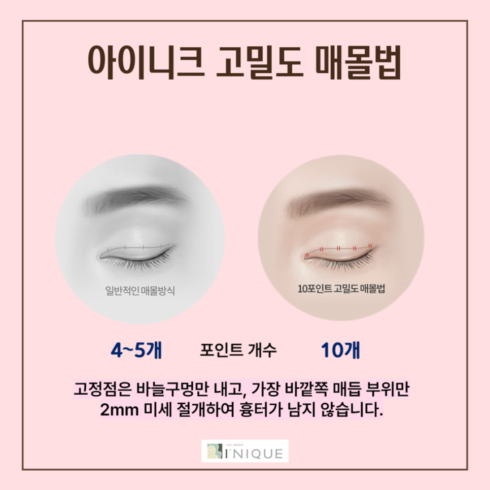 강남쌍꺼풀 자연스럽게 예뻐지는 방법 관련 이미지 3