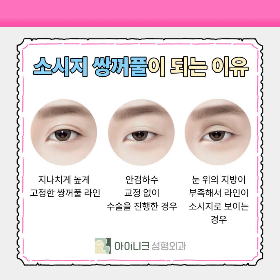 압구정 눈성형외과 소시지 주사로 바쁜 사람도 OK 관련 이미지 3