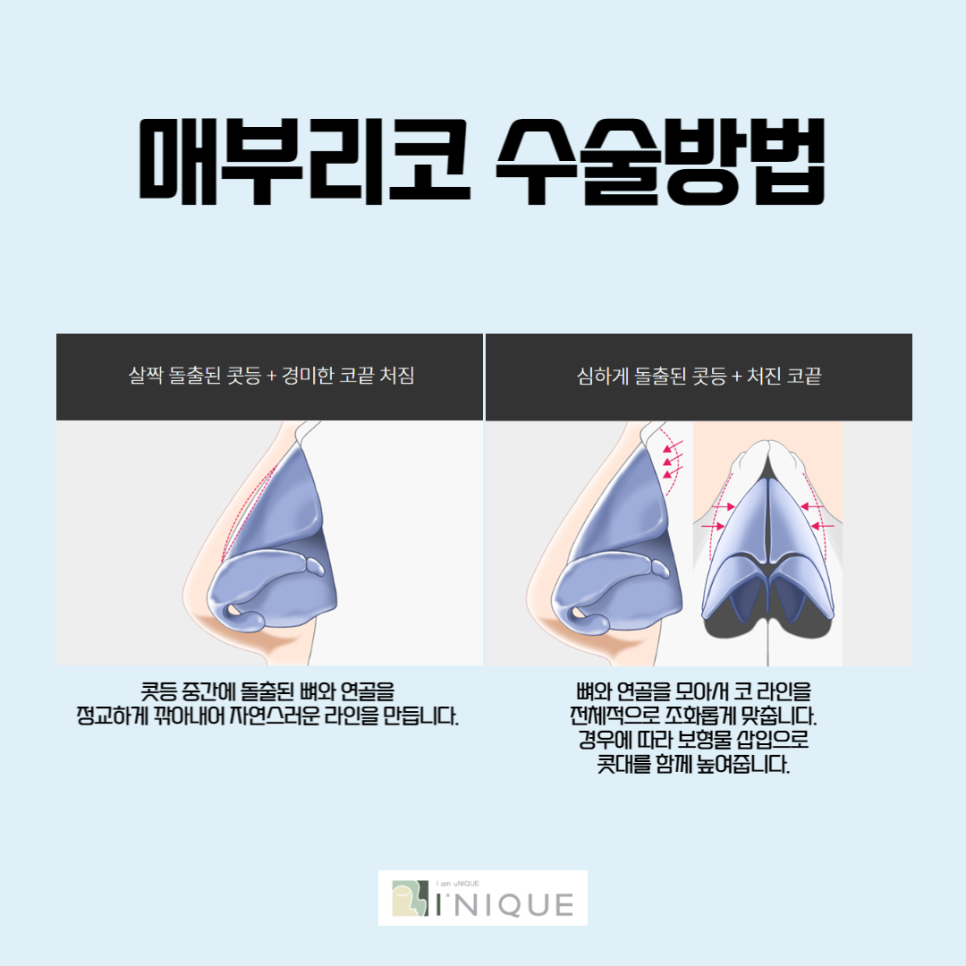 남자코성형후기가 많은 아이니크 관련 이미지 5