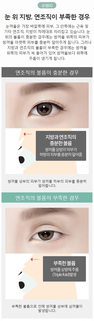 풀린쌍꺼풀 여러 겹의 쌍꺼풀 개선하는 방법! 관련 이미지 4
