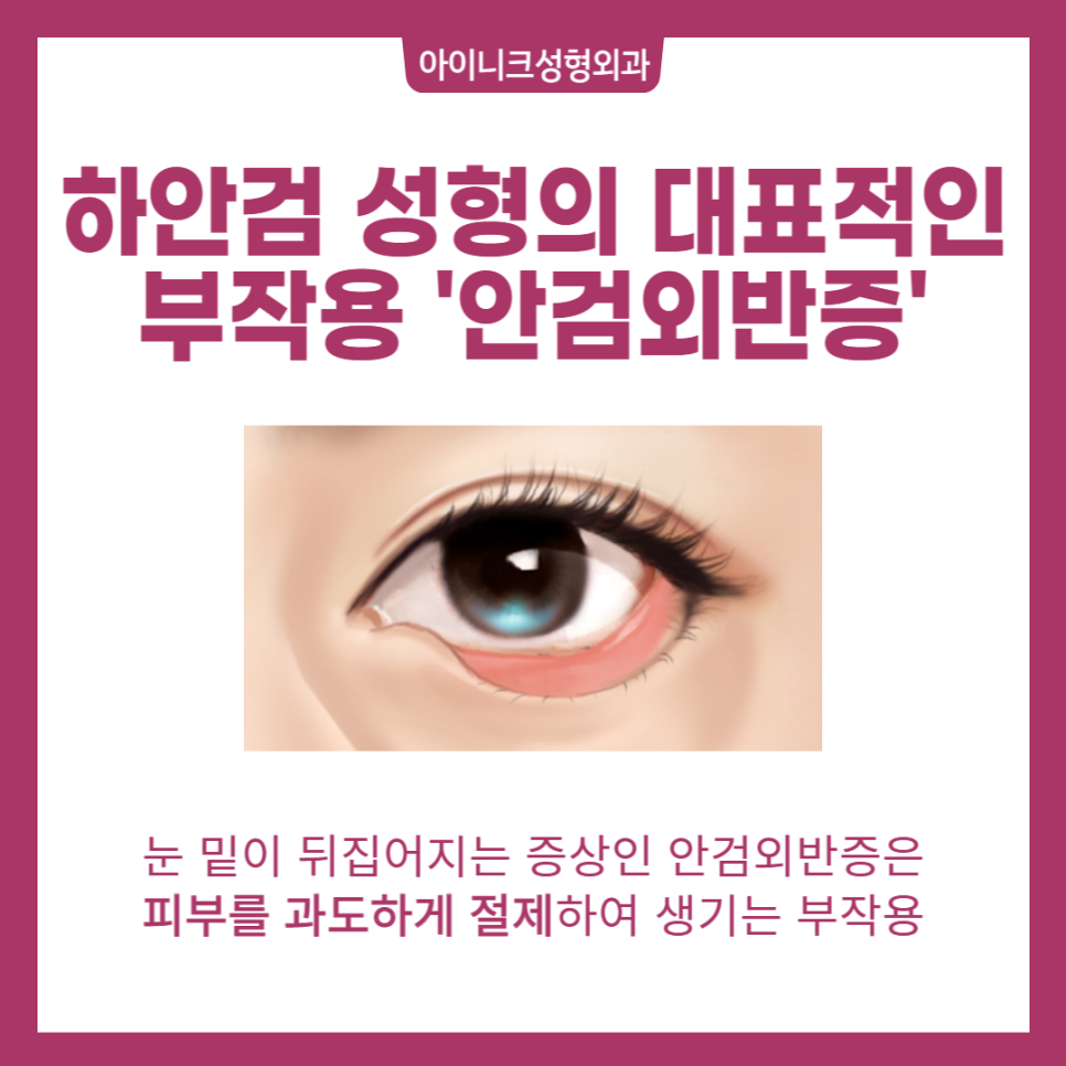Lower Blepharoplasty for the Under-Eye Area, Safe and Successful image 6