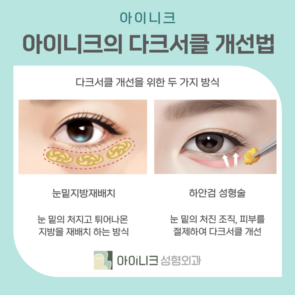 다크써클수술 어둡고 칙칙한 눈밑 개선하기 관련 이미지 10