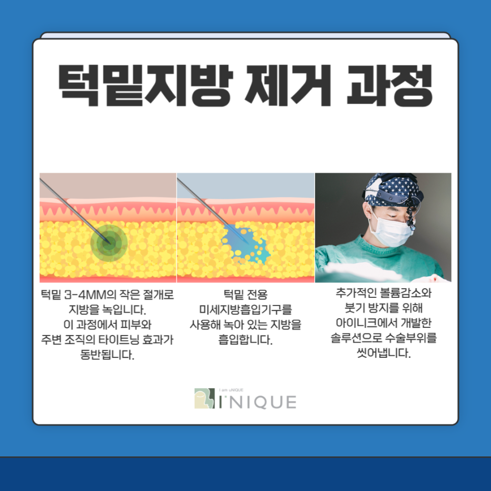 턱선시술 종류 및 효과 궁금하다면? 관련 이미지 3