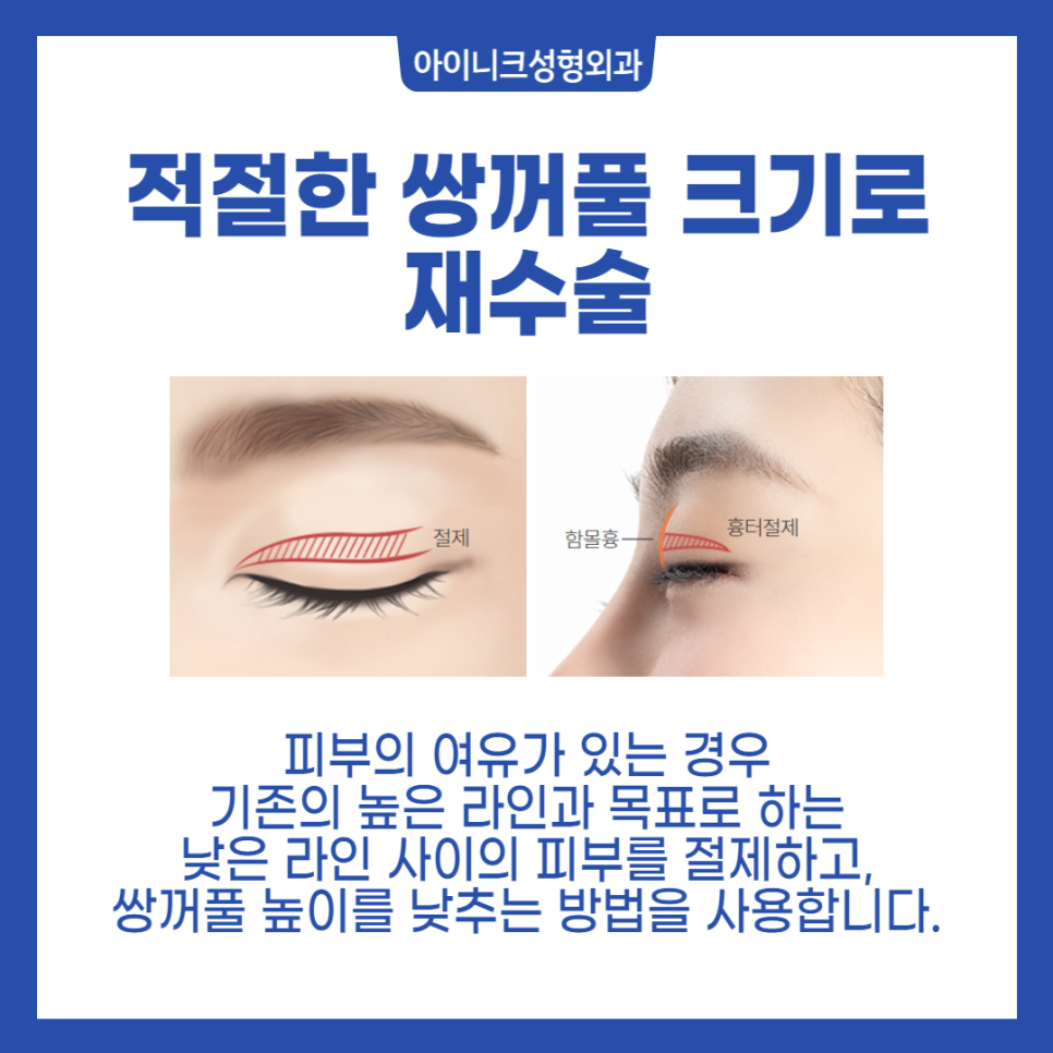 소시지눈재수술 원인부터 파악해야 실패 없어요 관련 이미지 3