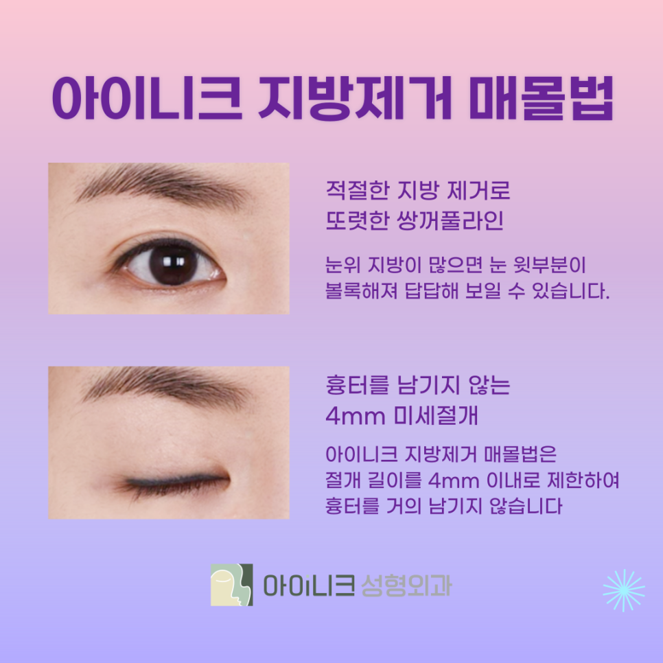 How Can You Make a Regret-Free Choice for Double Eyelid Surgery in Apgujeong? image 7