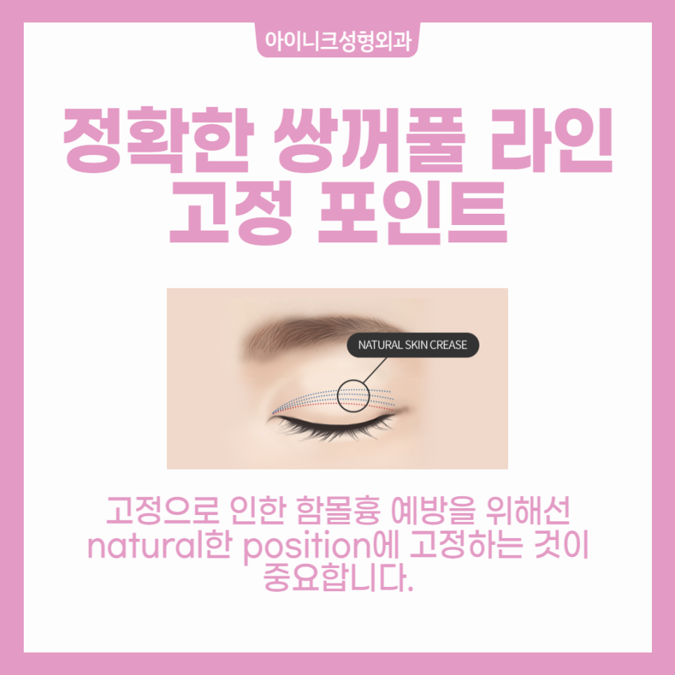 쌍수흉터, 쌍꺼풀 함몰흉 왜 생기는 걸까? 관련 이미지 4