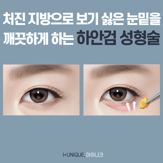 If You're Considering a New Year’s Gift of Filial Piety, Check Out the Types of Eye Surgery for People in Their 40s image 3