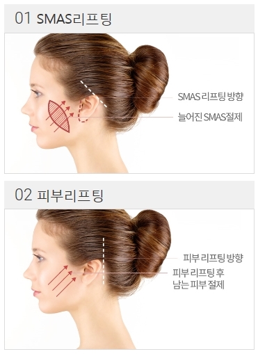 안면거상술회복기간이 걱정되나요? 관련 이미지 4