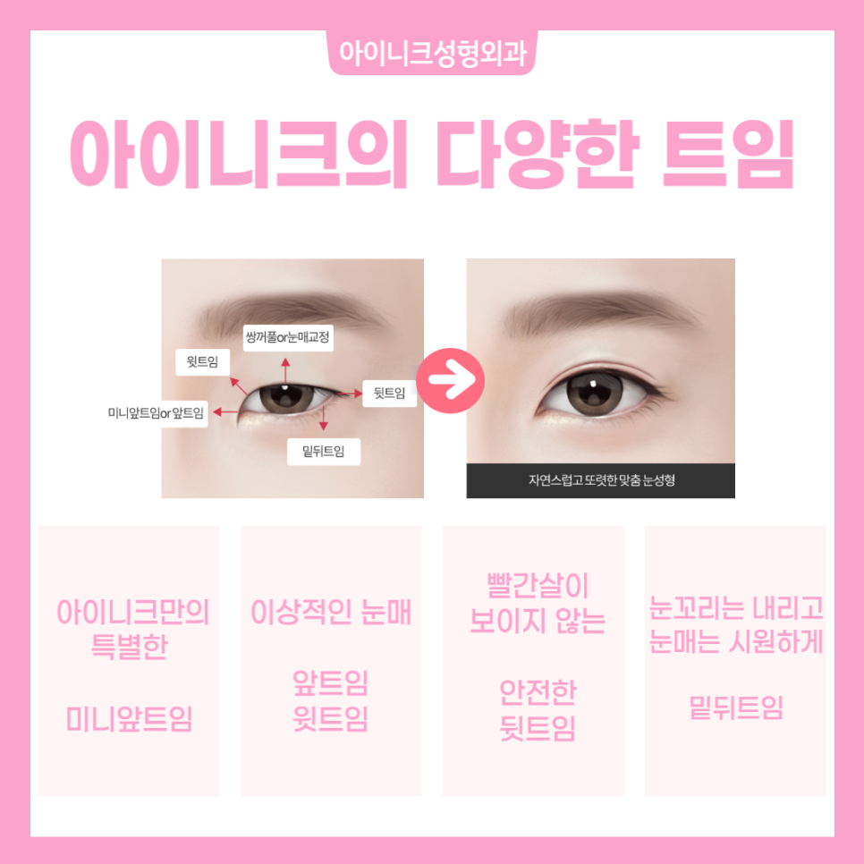 앞트임뒤트임 아름다운 눈을 위한 선택 관련 이미지 2