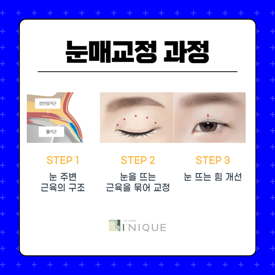 남자무쌍안검하수 자연스러운 교정을 원한다면 관련 이미지 4