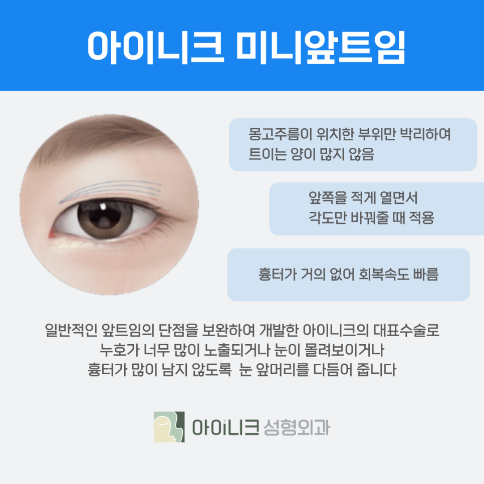 Why Epicanthoplasty Matters Especially for Men image 7