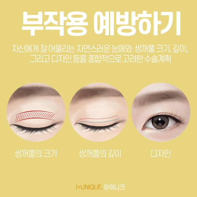 내 눈에 잘 맞는 자연스러운쌍수를 위해 알아야 할 점! 관련 이미지 3