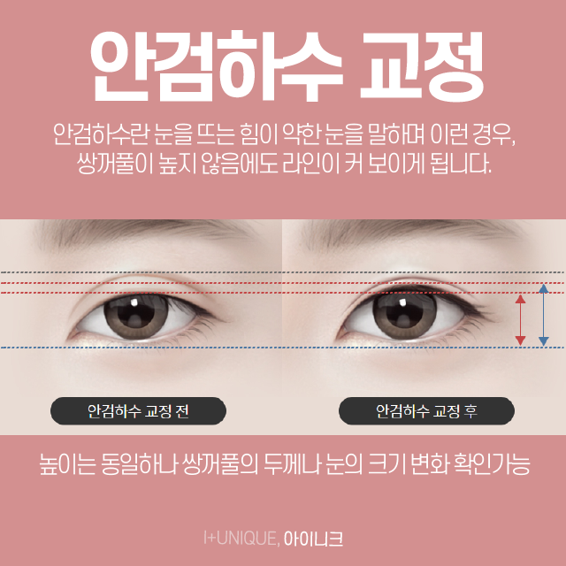 거울 볼 때마다 속상한 내 눈, 쌍커풀재수술병원에서 알아보자 관련 이미지 4