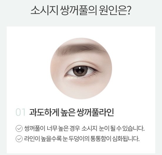 소시지눈재수술 자연스러움이 가장 중요 관련 이미지 2