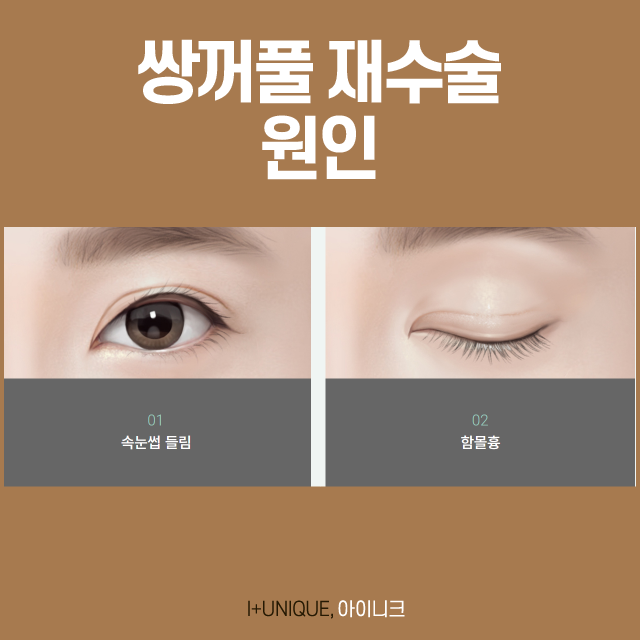 쌍꺼풀 재수술 방법 바로 알고 선택하자! 관련 이미지 2