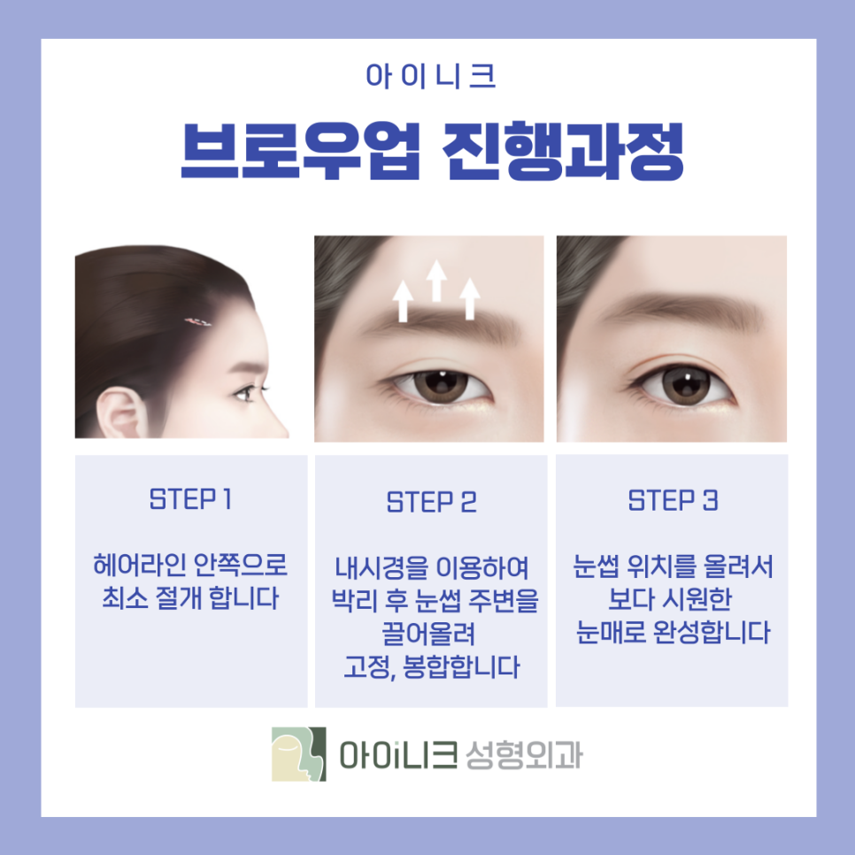 Plastic Surgery for the Eyes: Does Raising the Eyebrows Make the Eyes Look Clearer? image 8
