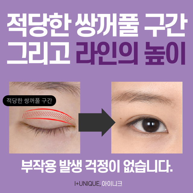 자연스러운쌍수를 위한 아이니크만의 솔루션 대공개 관련 이미지 2