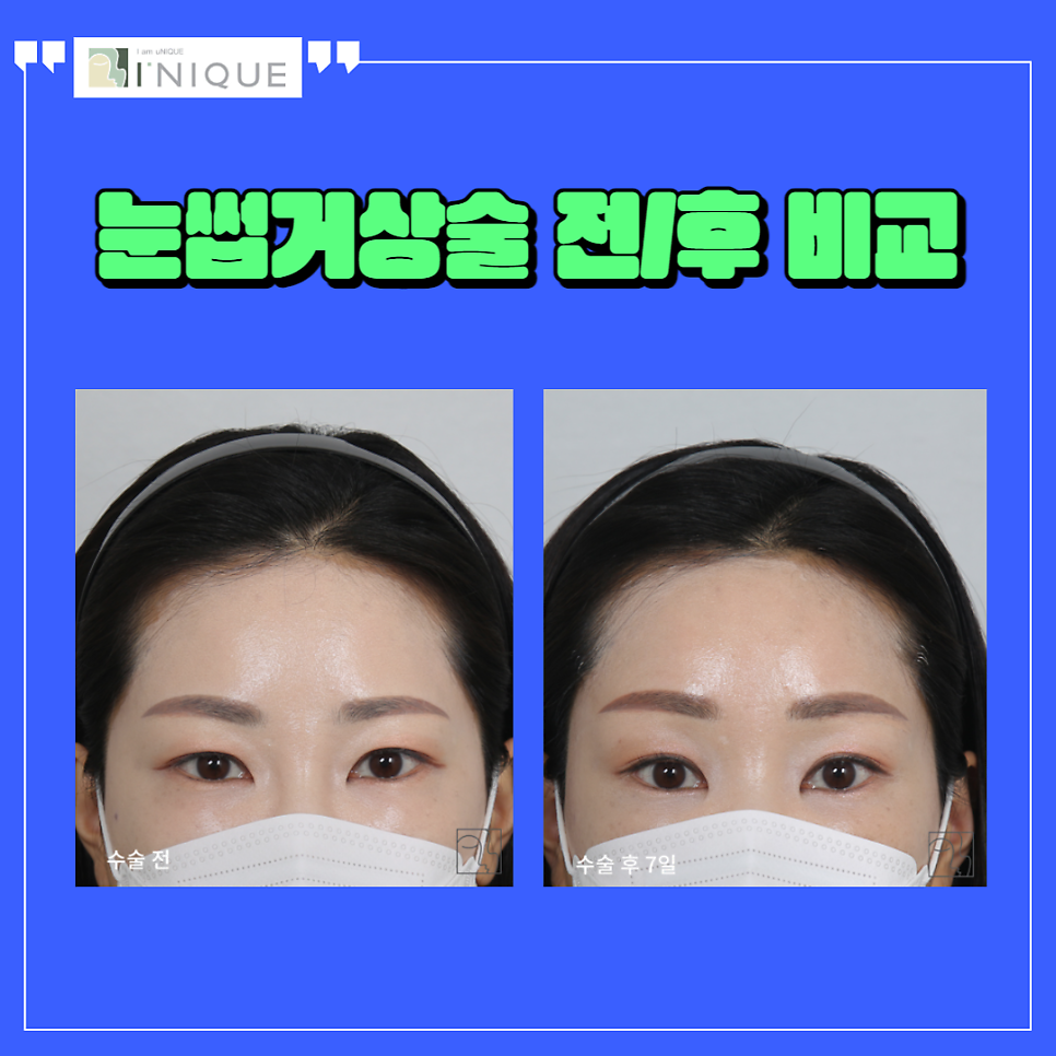 A Review of Creating a Clearer, Fresher Impression with Brow Lift Surgery image 6