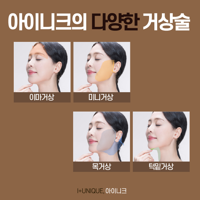 흘러간 세월을 잡는 안면거상술, 유지 기간부터 비용까지 관련 이미지 5