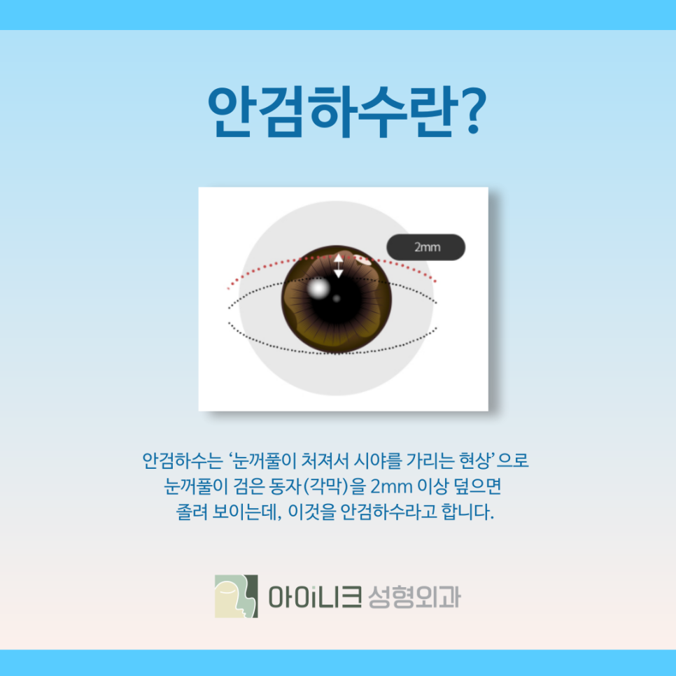 How to Improve Droopy Eyes with Ptosis Surgery in Seoul image 4
