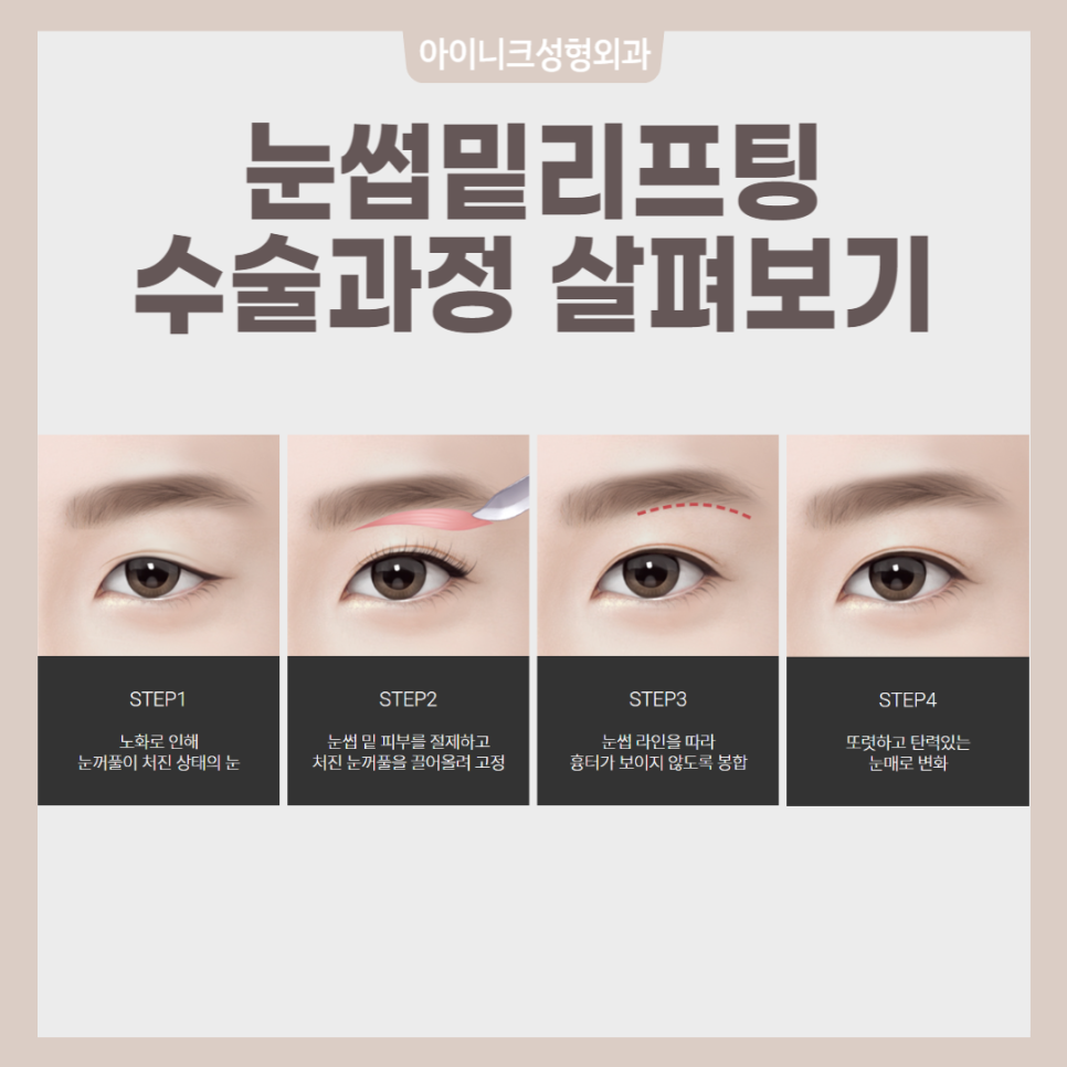 How Can You Get Recommended Midlife Eye Surgery Naturally Without Side Effects? image 2
