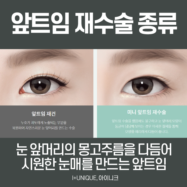 앞트임재수술 이번엔 제대로! 관련 이미지 2