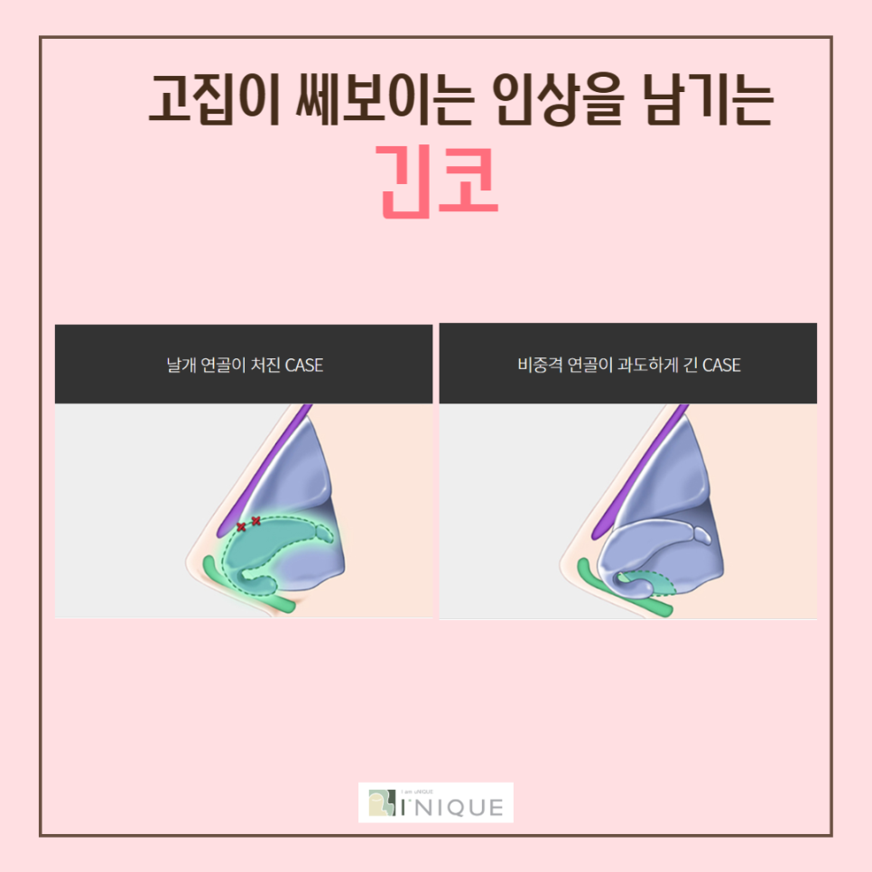여자코수술, 나에게 맞는 디자인으로! 관련 이미지 5