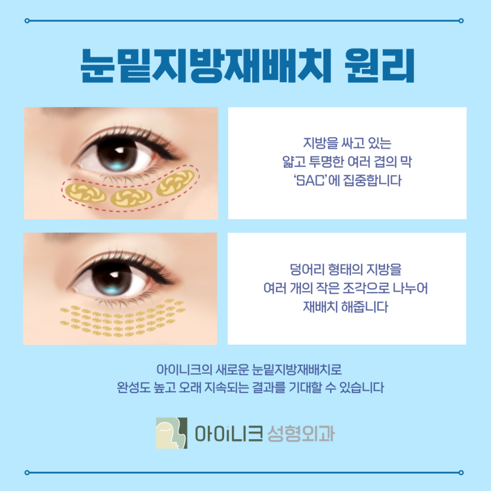 Improving Dark Circles with Under-Eye Fat Repositioning in Apgujeong image 5