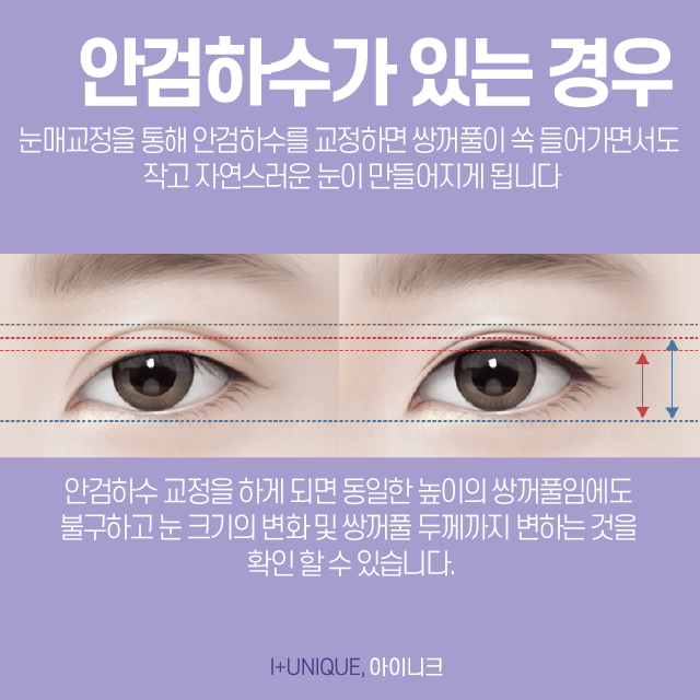 압구정쌍꺼풀재수술, 어떻게 하면 다시 자연스럽게 되돌릴 수 있을까 관련 이미지 4