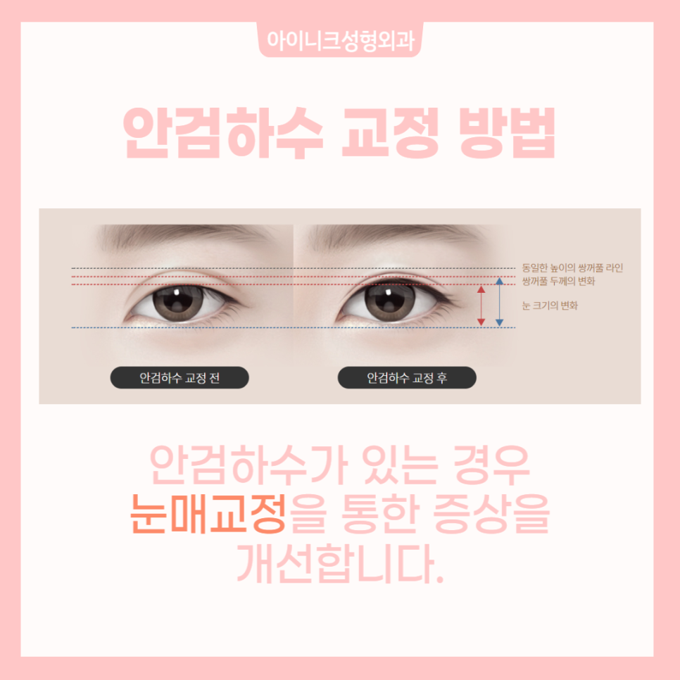 If You’re Curious About How to Succeed with Revision Surgery for a “Sausage Eye” image 4