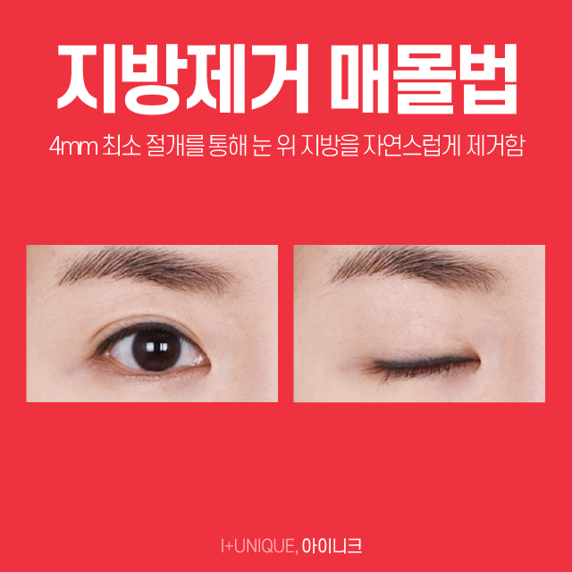 쌍수병원추천 수술의 종류를 알면 실력이 보인다! 관련 이미지 5