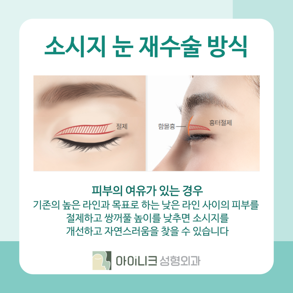청담역 눈재수술 병원 고민되시나요? 관련 이미지 5