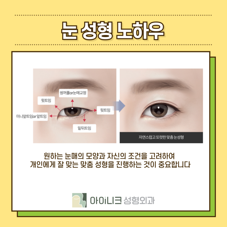 밑트임뒷트임 원하는 눈매에 맞게 진행하기 관련 이미지 6