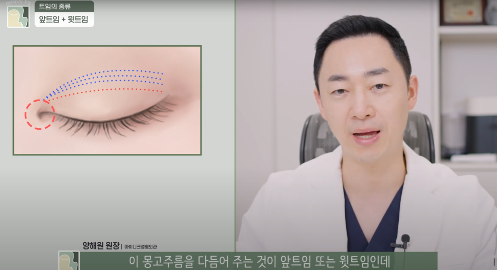 Upgraded with Apgujeong Eye Corner Surgery: Eyes That Look Twice as Large! image 4