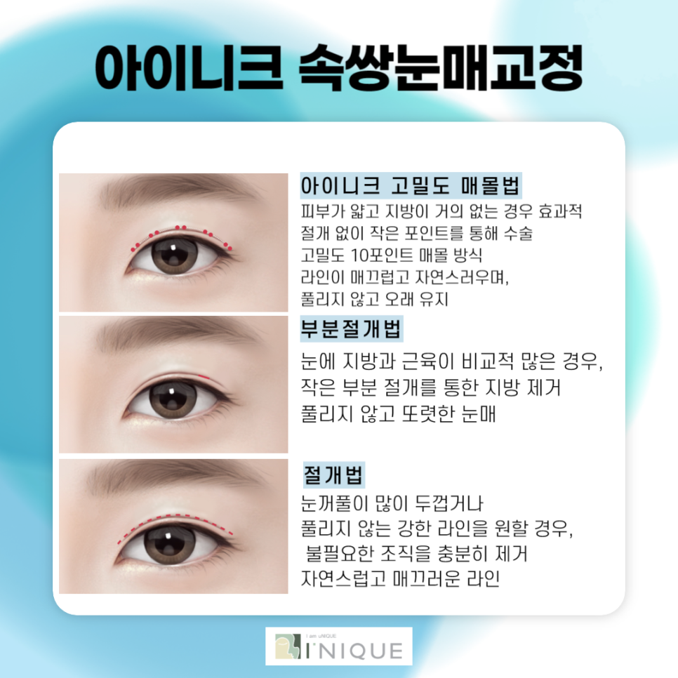 강남남자눈성형 부담스럽지 않은 또렷한 인상으로 관련 이미지 3