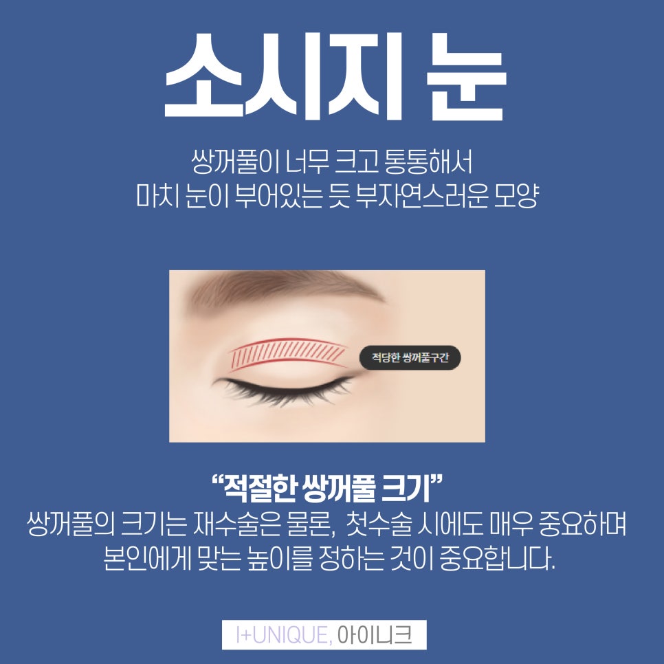 피부에 여유가 없는 쌍꺼풀도 소시지눈재수술이 가능하다 아이니크성형외과에서 관련 이미지 2