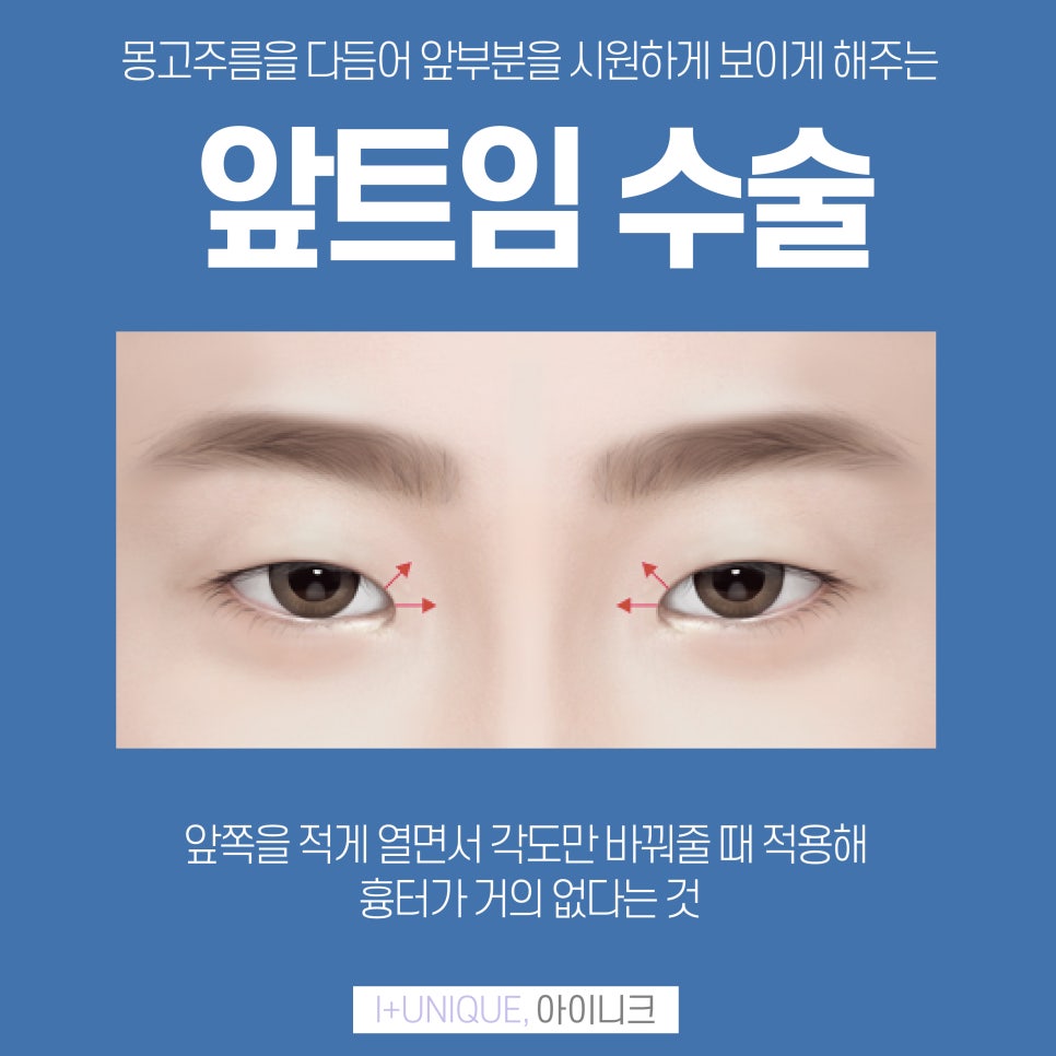 아이니크성형외과와 함께 트임종류 알아보자 관련 이미지 3