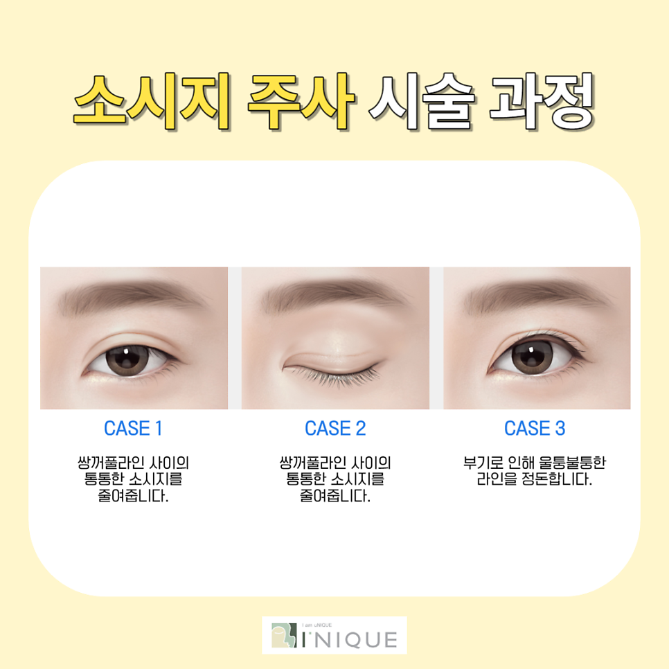 쌍수 후 관리 붓기 주사로 간편하고 안전하게! 관련 이미지 5